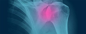 Xray scan of shoulder bone with pink highlight