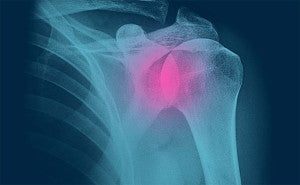 X-ray image of wireless implantable sensor in shoulder
