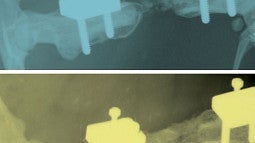 High-resolution radiograph images of bones after fracture 