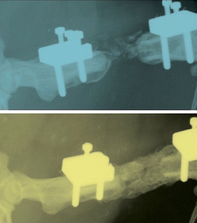 High-resolution radiograph image of bones after fracture — non-union (top),  healing (bottom)